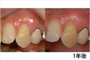 症例5　下がった歯ぐきの治療の症例