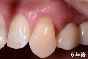 症例5　下がった歯ぐきの治療の症例