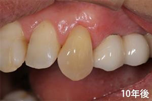 症例5　下がった歯ぐきの治療の症例