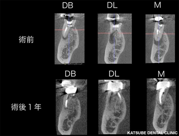 【CT術前術後】