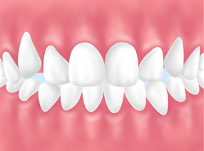 ガタガタの歯並び（八重(やえ)歯(ば)・叢生(そうせい)）