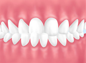 すきっ歯（空隙(くうげき)歯列(しれつ)）