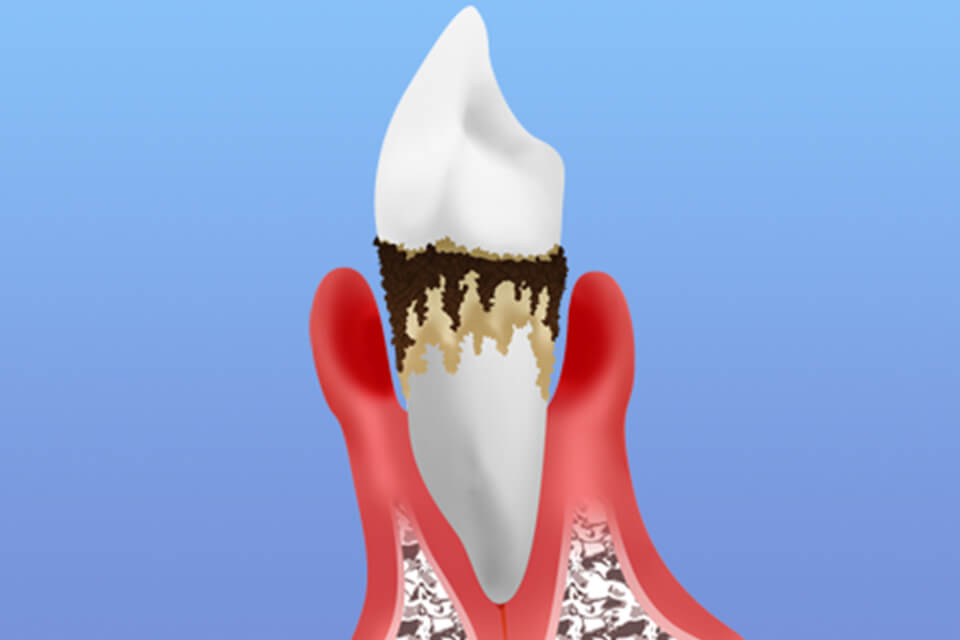 歯周病について