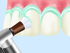 専門的な歯のクリーニング（PMTC）